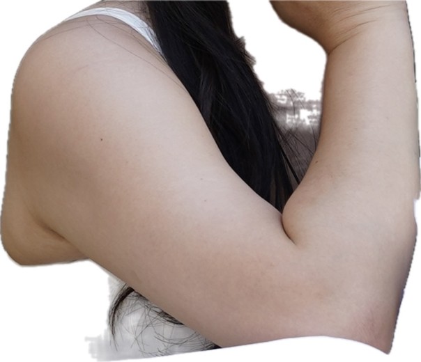 before photo: 팔지방흡입, 옆구리지방흡입, 복부지방흡입, 허리지방흡입