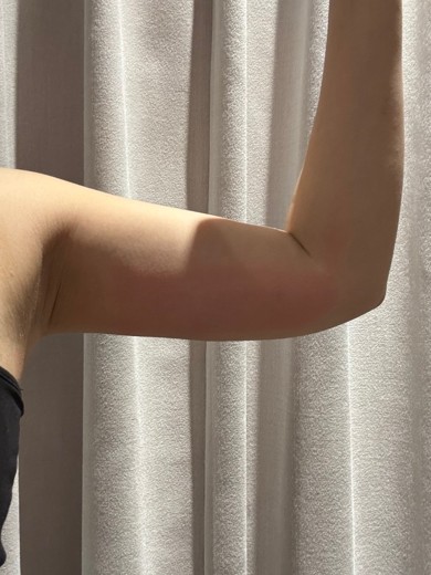 after photo: 脂肪溶解注射(腕)