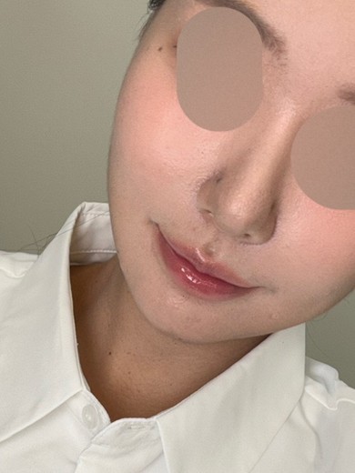 after photo: 실리프팅