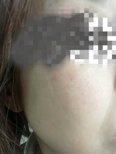 after photo: ピーリング, ルメッカ