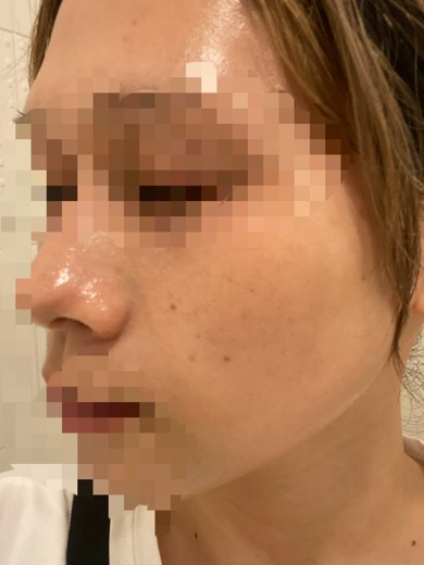 after photo: IPL(光/フォト治療), ピーリング