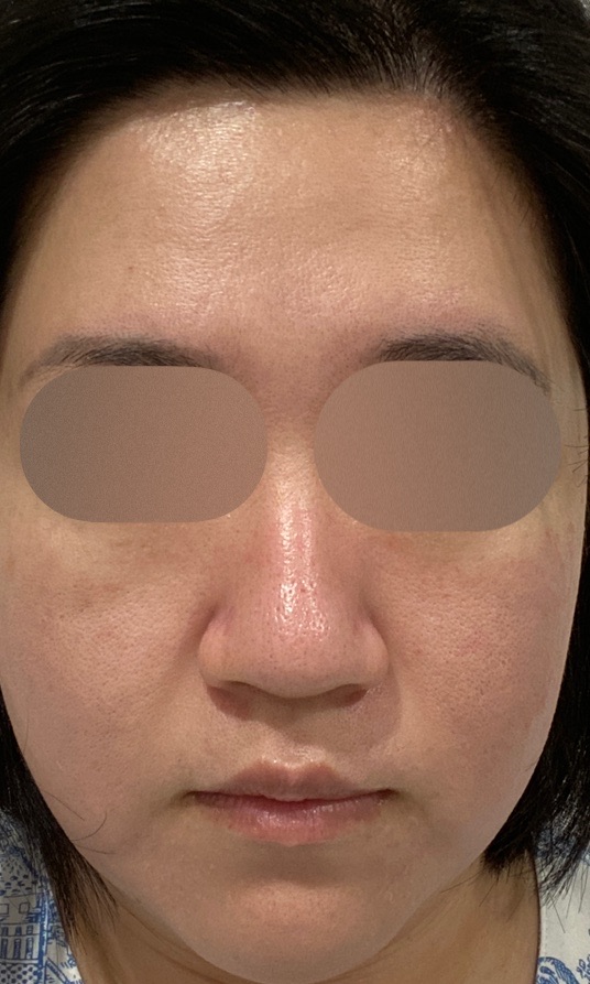 再来OK】ハイドラフェイシャル＋エレクトロポレーション