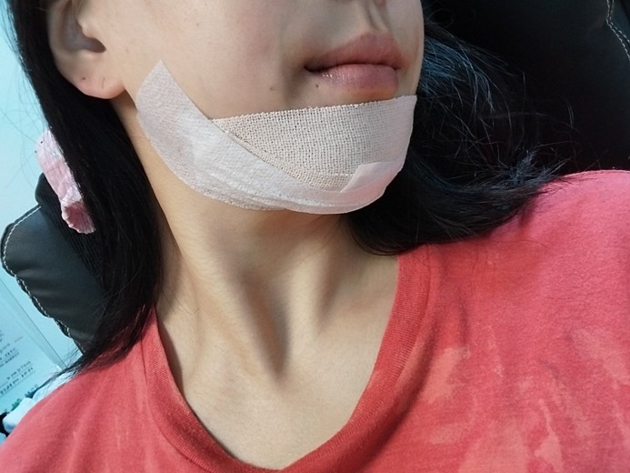 after photo: 턱끝보형물제거