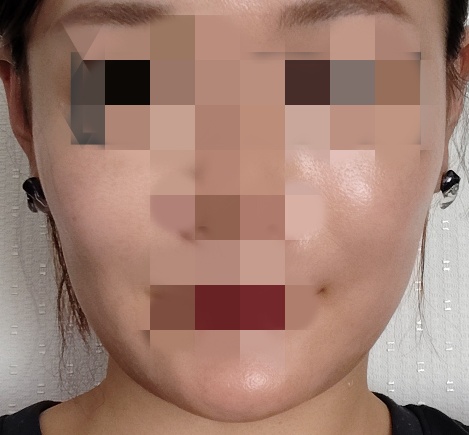 韓国製ヒアルロン酸注射｜ANOLVE（アノルブ）｜1cc 又は 入れ放題3