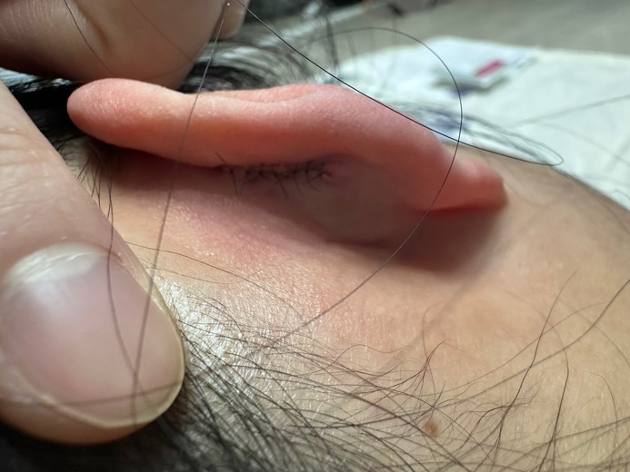 after photo: 캘로이드귀성형