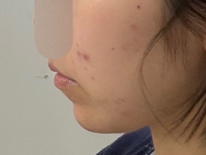 after photo: 턱끝필러