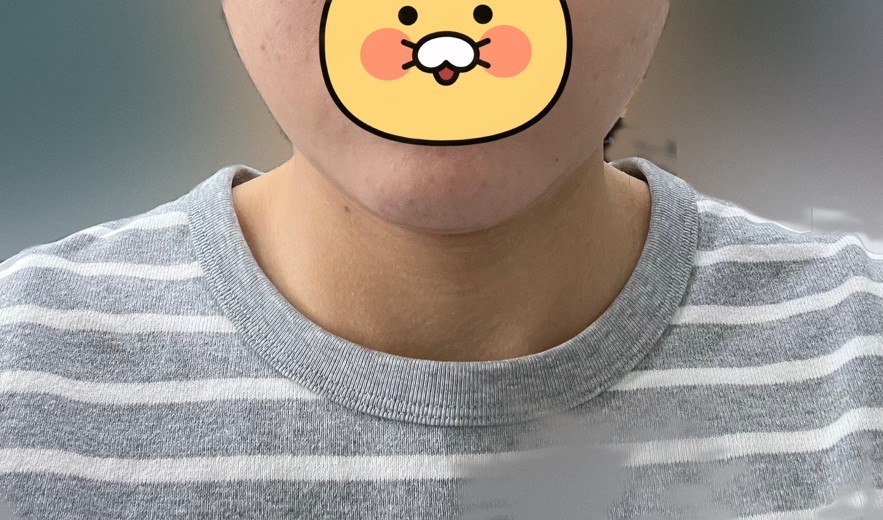 after photo: 윤곽주사