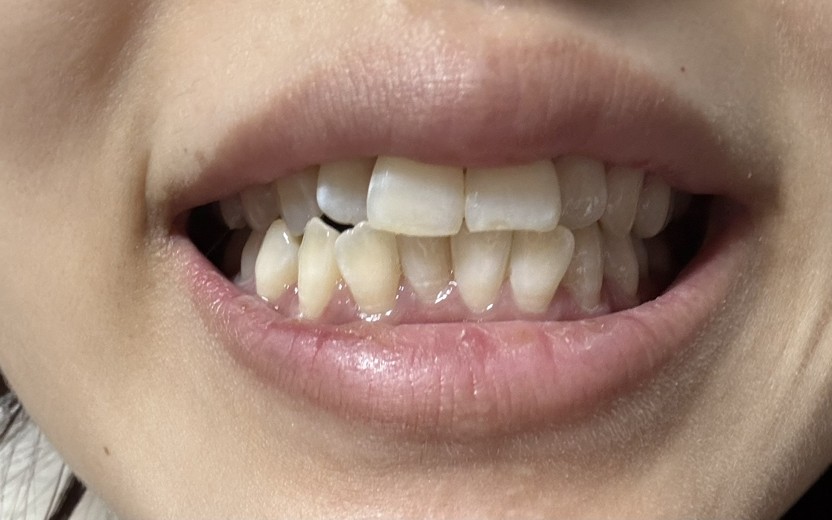 after photo: ホワイトニング