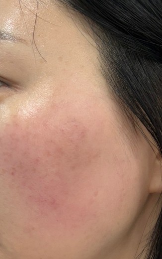 after photo: 리팟레이저