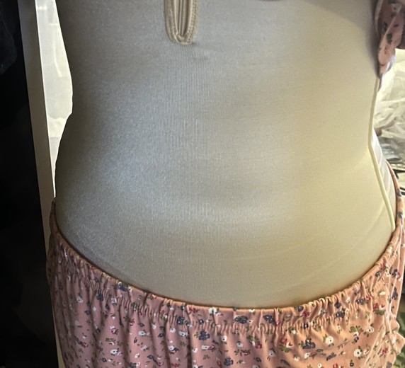 after photo: 복부지방흡입