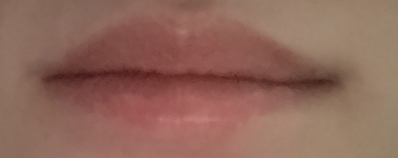 before photo: 입술필러