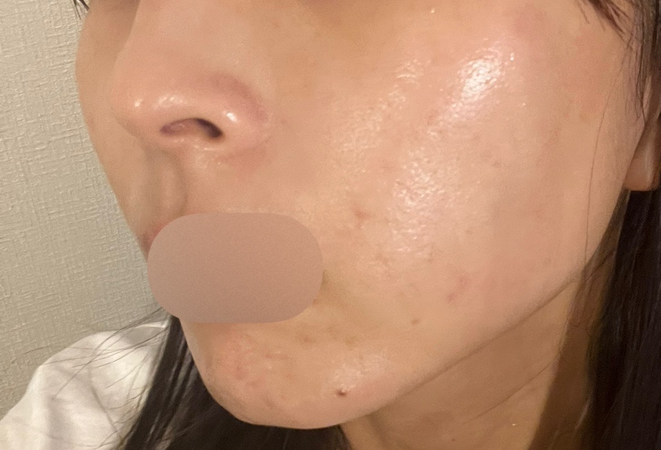 10月15日迄のご予約で初診料0円】IPL（光治療）全顔2周