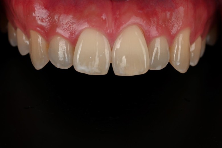 before photo: 라미네이트