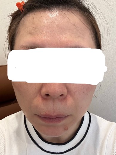 before photo: ハイフ(HIFU)