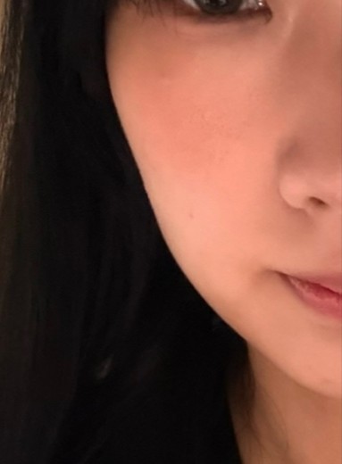 after photo: ハイフ(HIFU)