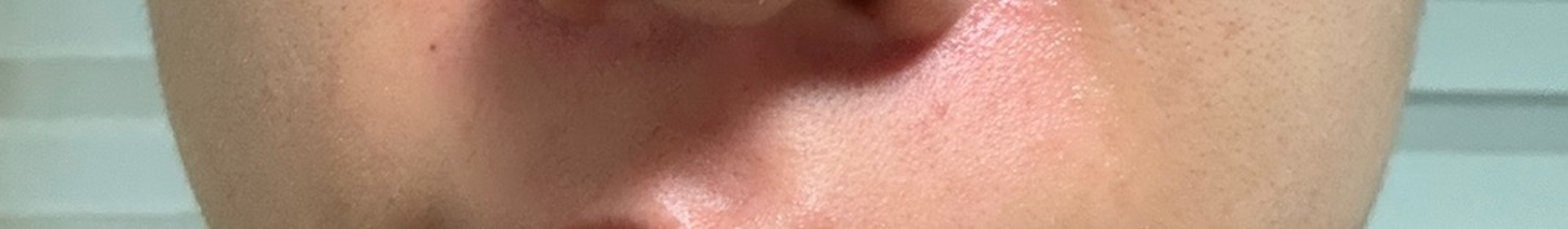 after photo: 인중제모