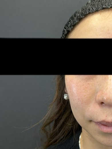 before photo: ダーマペン