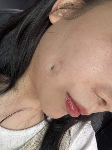 before photo: 보조개성형