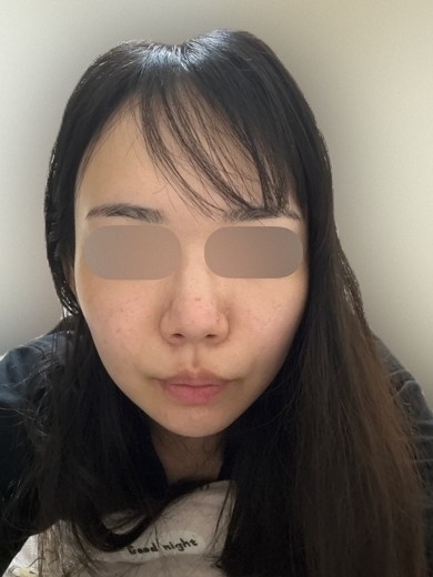 before photo: サーモン注射