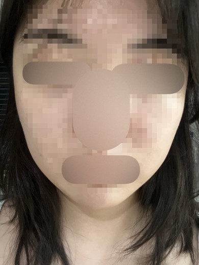 after photo: 사각턱보톡스