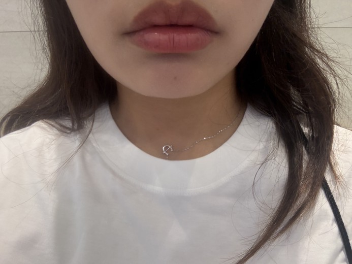 before photo: 입꼬리필러, 입꼬리보톡스