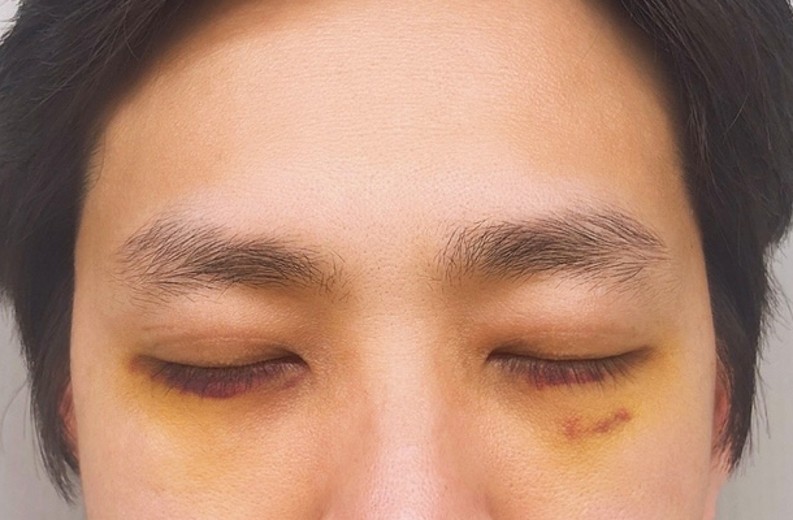 after photo: 눈밑지방재배치