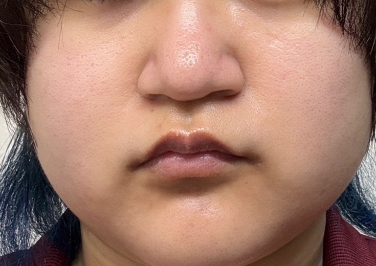before photo: ダーマペン