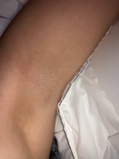 before photo: 겨드랑이제모