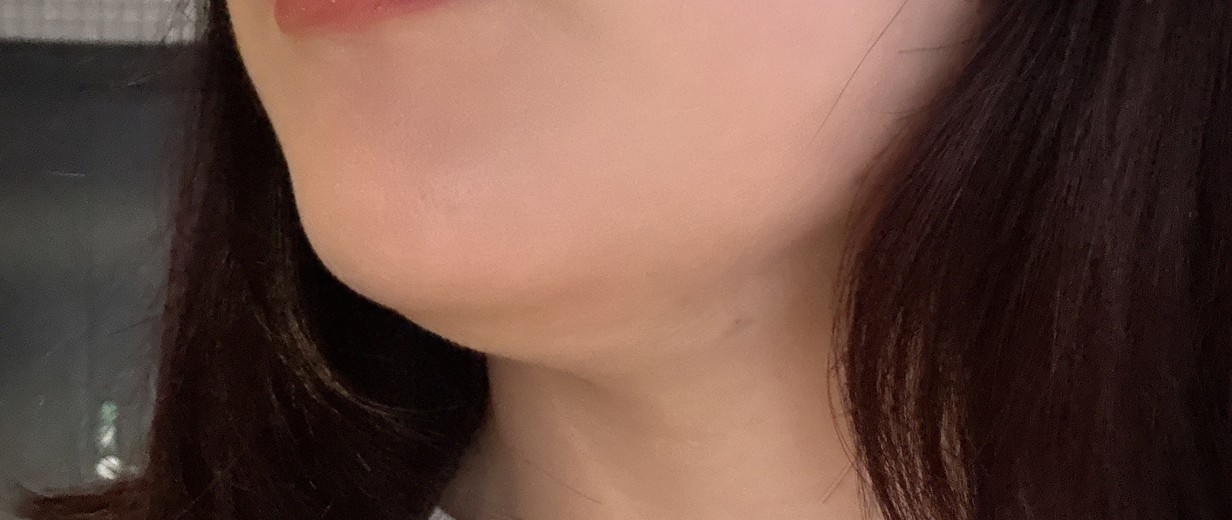after photo: 脂肪溶解注射(顔)
