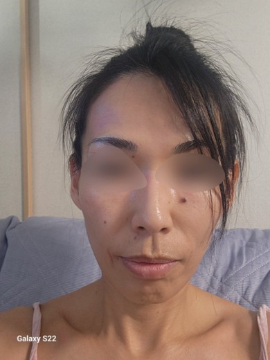 before photo: 水光注射