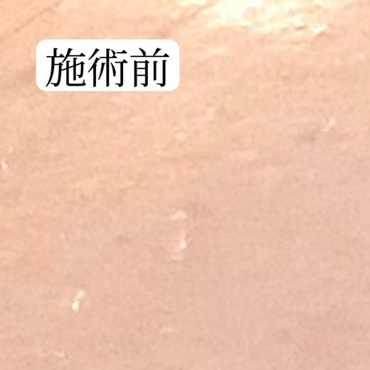 before photo: エレクトロポレーション