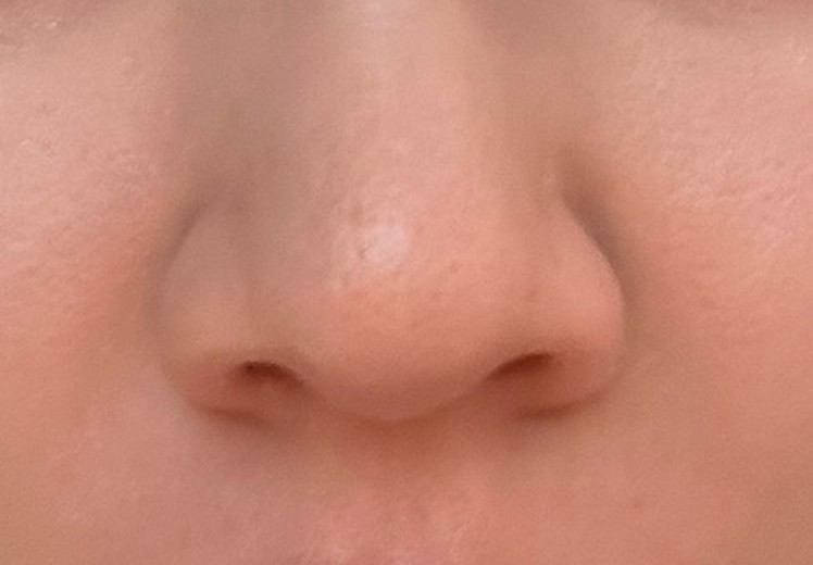 after photo: 脂肪溶解注射(顔)