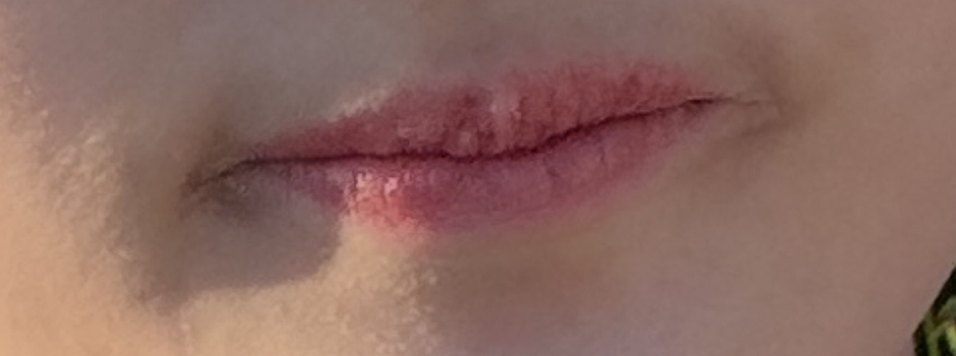 before photo: 입꼬리필러, 입술필러