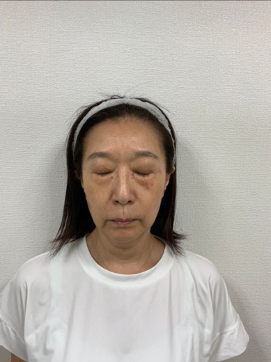 before photo: ピコスポット