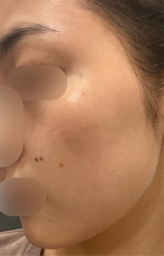 after photo: エレクトロポレーション