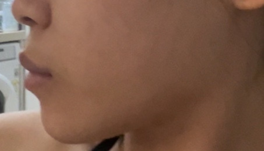 after photo: 턱필러