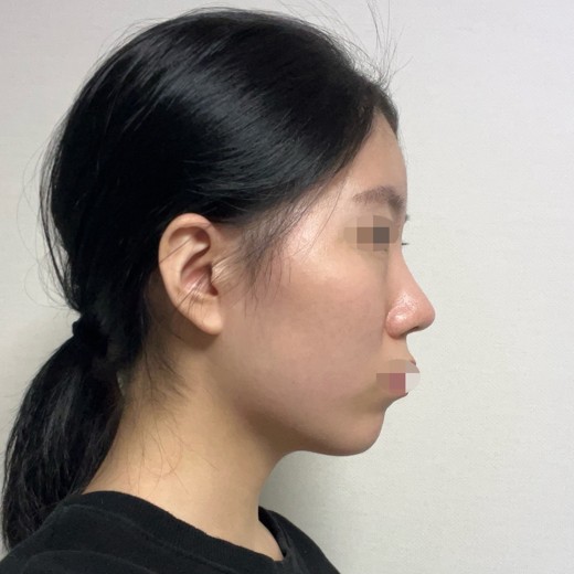 after photo: 코끝(자가연골)