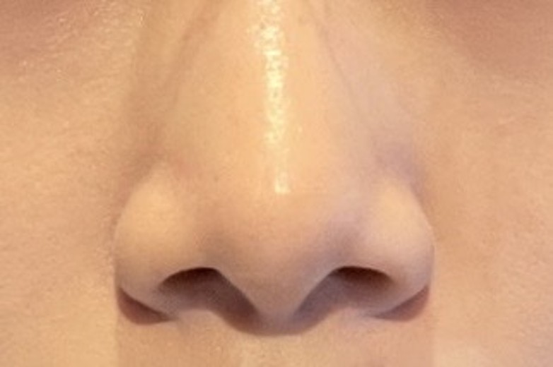 before photo: 콧볼축소