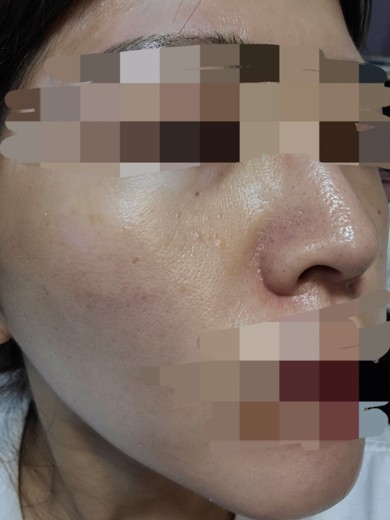 after photo: ハイドラフェイシャル, 診断・検査