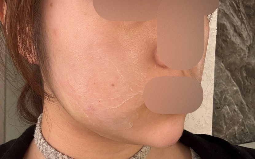 after photo: 턱끝필러