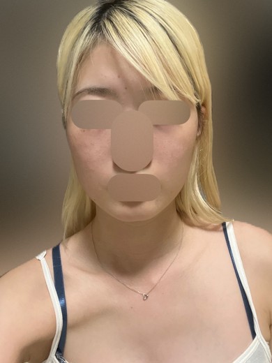 after photo: インモード