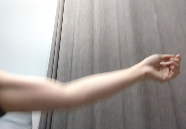 after photo: 脂肪溶解注射(腕), 脂肪溶解注射(太もも)
