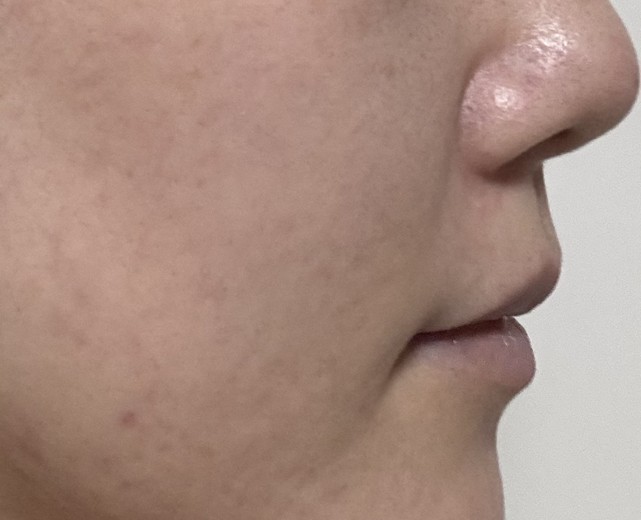 after photo: IPL(光/フォト治療), ピーリング, エレクトロポレーション, ルメッカ