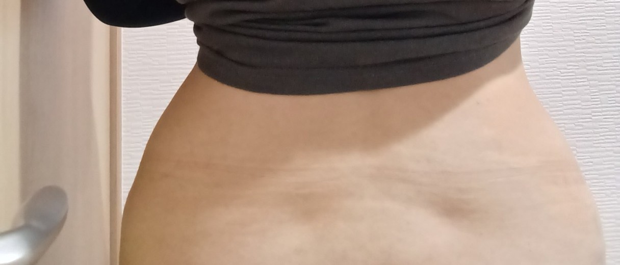 after photo: 高周波脂肪溶解(腹部)