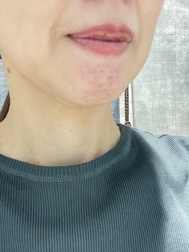 before photo: ダブロ(ハイフ)
