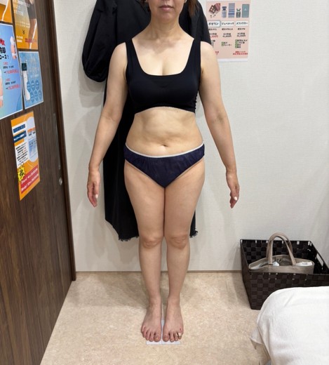 after photo: 脂肪冷却(腹部)