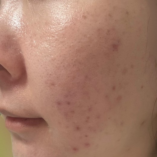 after photo: IPL(光/フォト治療), 診断・検査