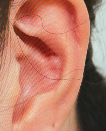 before photo: 캘로이드귀성형