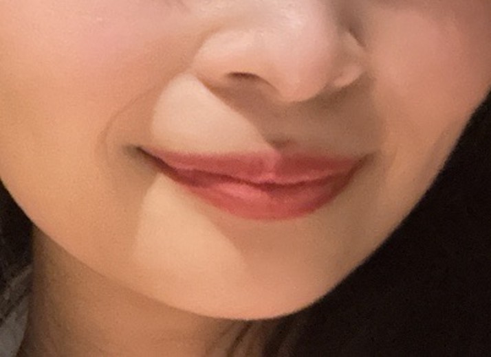 before photo: ほうれい線ヒアルロン酸