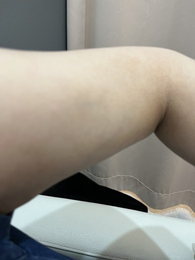 before photo: 脂肪溶解注射(腕)